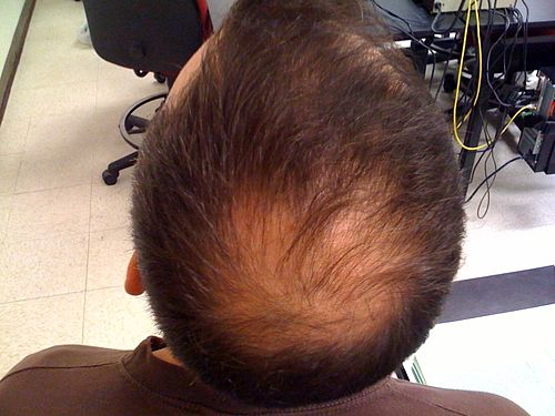 Hair loss